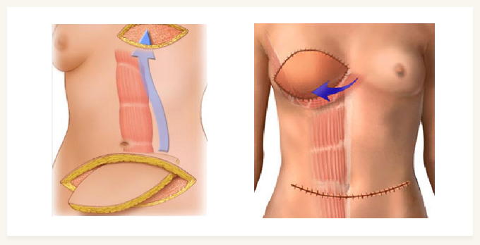 복직근을 이용한 성형술을 이용한 방법에 관한 참고 이미지