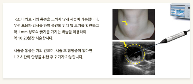      ʰ ü մϴ. 켱  ˻縦 Ͽ  ġ  ũ⸦ Ȯϰ  1 mm  ⸦  ٴ ̿Ͽ  10-20а üմϴ. ü   , ü  պ ٸ 1-2 ð    Ͱ մϴ. 